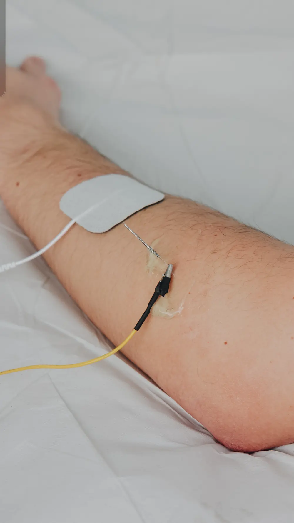 Aplicación avanzada de electropunción en fisioterapia en Evolucenter Móstoles para tratamiento de dolor musculoesquelético
