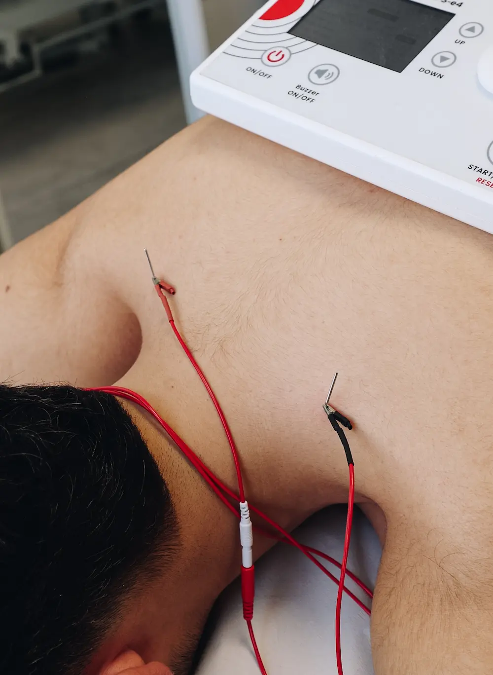 Electropunción percutánea aplicada en sesión de fisioterapia avanzada en Evolucenter Móstoles