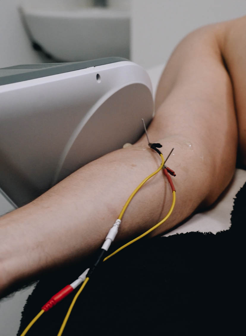 Neuromodulación percutánea